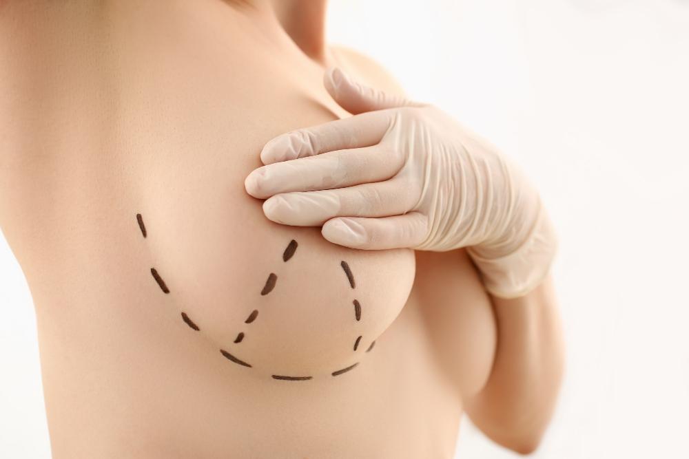 breast Eine Bruststraffung Türkei kosten antalya preis