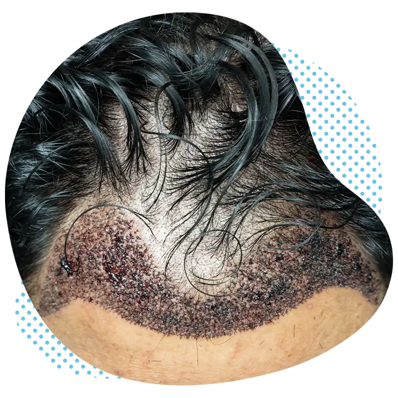 пересадка волос дхи