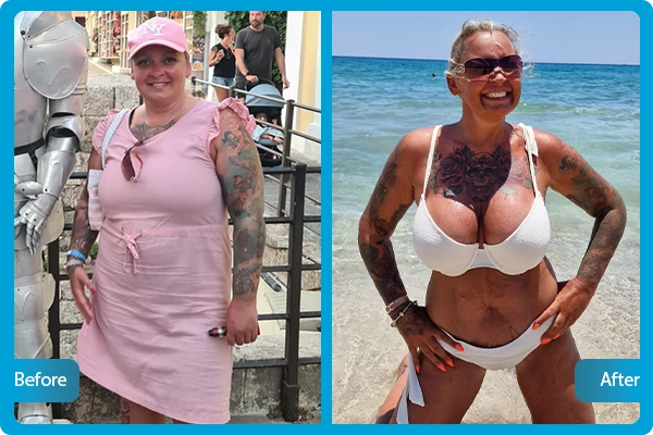Gastric Sleeve Before After