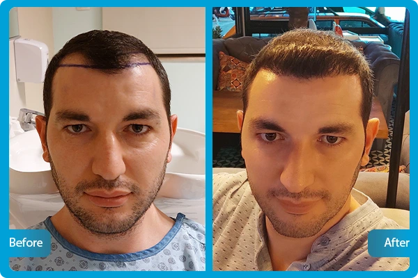 DHI Hair Transplant Turkey - Aesthetic Travel in Antalya